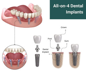 all-on-4-dental-implants All on 4 dental implants